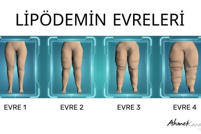 Kilo veremiyorsanız suçlu iradeniz değil, lipödem olabilir.